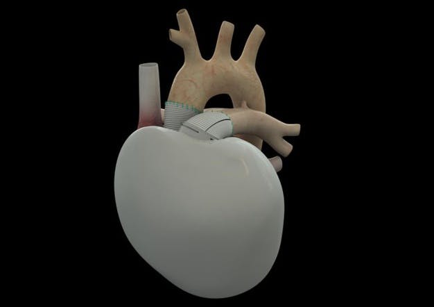 Un troisième coeur artificiel a été greffé à Paris