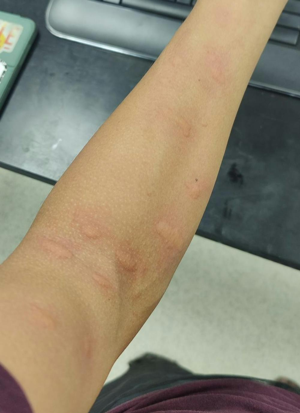 Bras avec des piqûres de moustiques visibles sur la peau, fond de sol gris et noir.